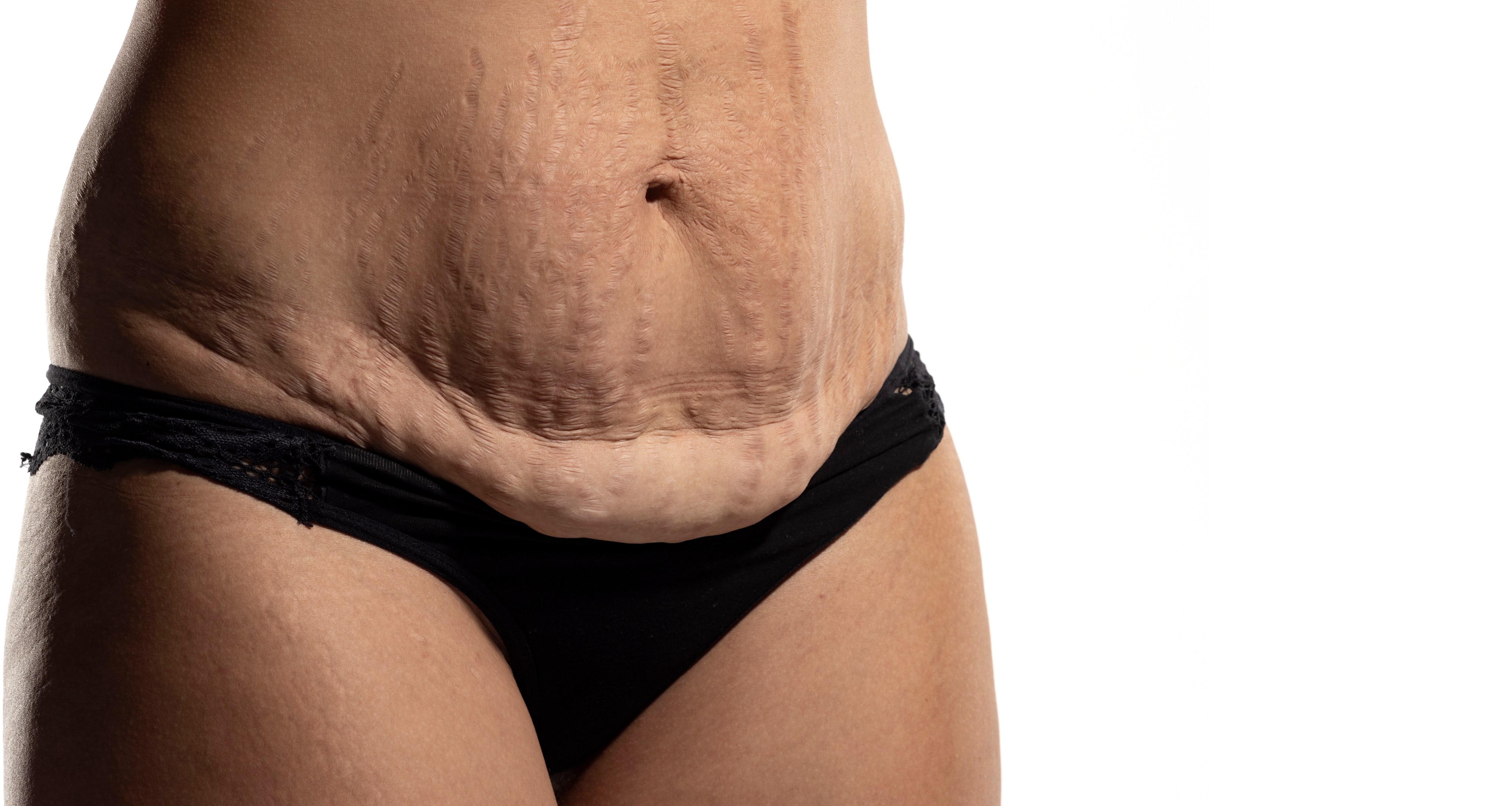 Abdominoplasty